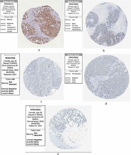 Figure 9. The expression of the genes in breast cancer and normal tissues in HPA. (a) KLRB1. (b) SIT1. (c) GZMM. HPA: the Human Protein Atlas