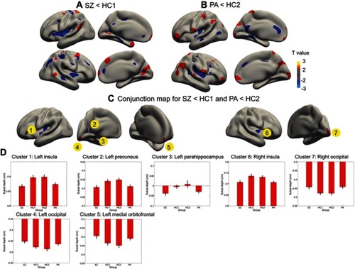Figure S1 Cortical statistical maps displaying sulcal depth abnormalities in patients with schizophrenia (SZ) compared with young healthy controls for the SZ (HC1) (A), and in unaffected biological parents of patients (PA) compared with old healthy controls for the PA (HC2) (B), and the conjunction map for SZ<HC1 and PA<HC2 (C). (D) Mean ± SEM sulcal depth of the 7 clusters identified in the conjunction analysis. A and B show regions with uncorrected P<0.05. The colour bar indicates T-values.