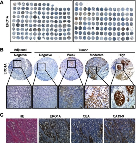 Figure 1 ERO1A protein expression in CCA tissues. (A) IHC staining for ERO1A protein expression in 222 cases of CCA tissue microarray. (B) a: Negative ERO1A staining in normal liver tissue; b: Negative ERO1A staining in CCA; c: weakly positive ERO1A staining in CCA; d: moderate positive ERO1A staining in CCA; e: strongly positive ERO1A staining in CCA (400×). (C) The expression of ERO1A, CEA, and CA19-9 in CCA tissue (200×).