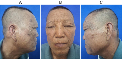 Figure 1 (A–C) Diffuse thickening of facial skin, thickening of skin lines and furrow deepening.