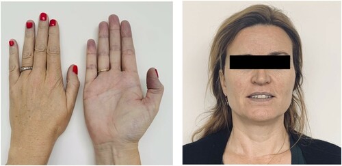 Figure 1. Patient presentation. Noticeable are the cyanotic features in her extremities as well as distinct cyanotic discoloration of her lips.