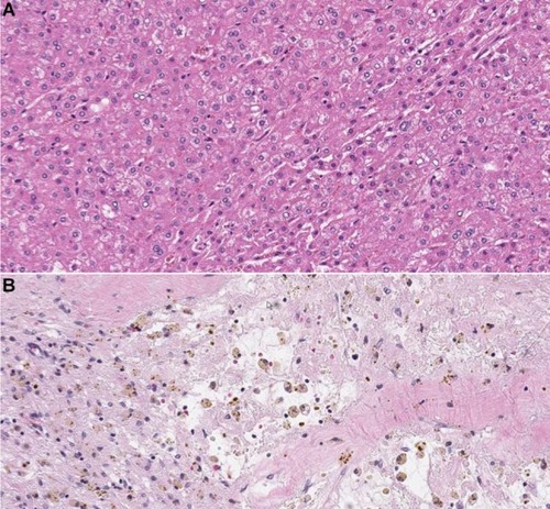 Figure 2 Hematoxylin-eosin staining showing moderately-differentiated HCC (A). At immunohistochemical staining (B), the tumor shows expression of β-catenin protein in the nucleus and/or cytoplasm. Magnification ×200.