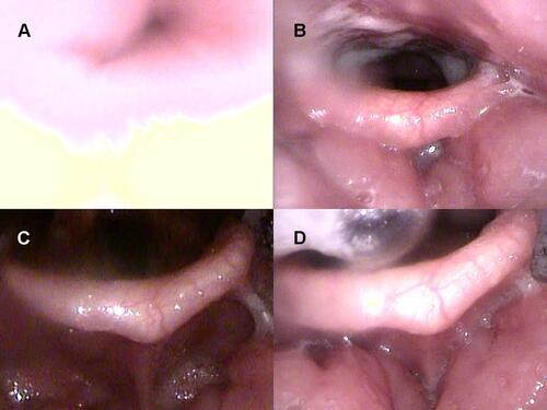 Figure 6 Drug-induced sleep endoscopy results at the tongue base level: supine position. No intermittent negative airway pressure (iNAP) therapy during (A) inspiration and (B) expiration. Application of iNAP therapy during (C) inspiration and (D) expiration.
