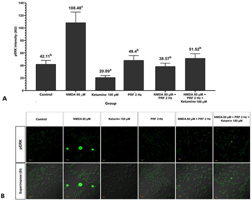 Figure 5 PRF decreases neuron sensitization in the sensitized DRG neuron. (A) Sensitized neurons significantly had a higher pERK than the control and other groups. PRF exposure to sensitized cells had a lower pERK intensity than unexposed neurons. (B) Fluorescent imaging show pERK expression. The abc notation indicates statistical differences between groups. The same notation indicate no significant difference. Description: Superimpose (SI): description of the combined observations of pERK and DIC (differential interference contrast) observations. Magnification: 400X.