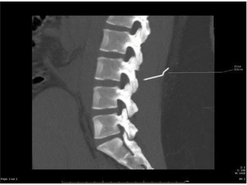 Figure 1 A lumbar spine CT scan.