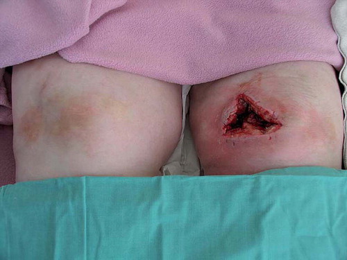 Figure 1. Postoperative photograph of both knees (anterior view), illustrating the large cavity following surgical incision, drainage and debridement of the abscess secondary to corticosteroid knee joint injection.
