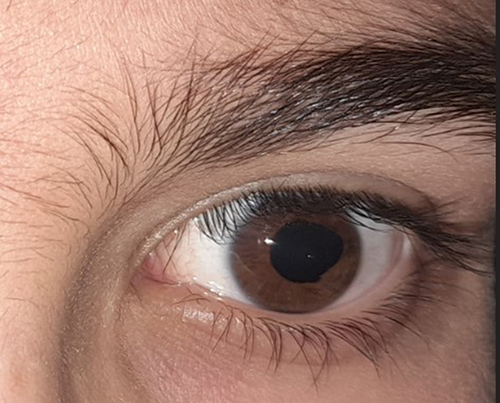 Figure 2 Shows lateral temporal iris coloboma in the left eye of the patient.