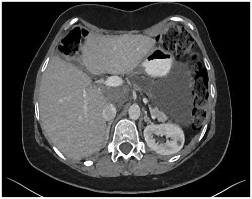 Figure 2. Routine follow up CT imaging of patient two demonstrated fluid along the greater curvature of the stomach that has remained stable for >4 years.