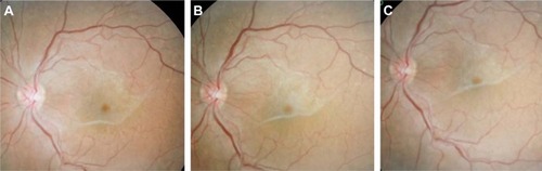 Figure 2 Auto-peeling of idiopathic ERM can be seen in these fundus photos from a 76-year-old female with idiopathic ERM. These photos were taken in (A) August 2008, (B) November 2009, and (C) February 2012.