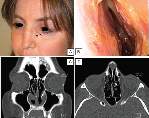 Figure 2 A) Postoperative view of the patient confirming the disappearance of the dacryocele (black arrows). B) Postoperative endoscopy of the left nasal cavity showing the absence of recurrence of the adhesions posteriorly. C and D) Postoperative dacryoscan confirming the patency of the surgical opening on the left side: presence of medium contrast in the nasal cavity (white arrow).