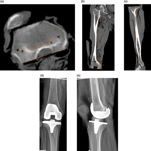 Figure 7. Imaging examination showing good positioning of the prosthesis. (a) The resection of the posterior surface is parallel to the transepicondylar axis. (b) and (c) The distal resection of the femur and the proximal resection of the tibia are almost perpendicular to the mechanical axis of the leg in the coronal plane. (d) and (e) X-rays of the knee in anteroposterior and lateral views following TKA showed normal alignment of the knee with an intact prosthesis.