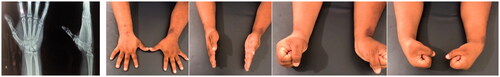 Figure 3. Follow up radiographs of wrist and clinical photos after 2 months.