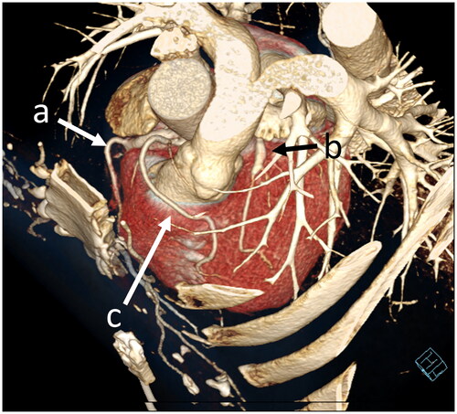 Figure 2. Another CCTA scan revealing single coronary artery(a) and two vessels (b,c) arising from the dominant one.