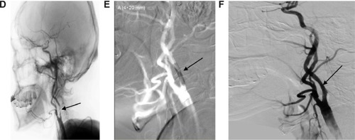 Figure 1 A stroke patient of right side severe internal carotid artery stenosis (>50% lumen reduction) treated with stenting revascularization.