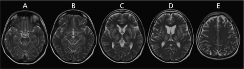 Figure 2. Representative images of T2-weighted sequence of Case 1. A. Upper pontine and lower midbrain axial cut; there are hyperintensities over the dorsal region B. Upper midbrain axial cut; there are confluent hyperintensities over the midbrain tegmentum C. Sylvian fissure axial cut; there are prominent hyperintensities over the lateral thalami, caudate, and putaminal region D. Insular region axial cut; extensive bilateral hyperintensities over the thalami and basal ganglia are seen E. Corona radiata axial cut; bilateral centum semiovale were spared of any signal abnormality