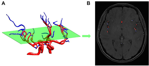 Figure 1 (A) A representative 3D cerebral vascular reconstruction after segmentation of MRA images using a 3D region growing algorithm. The green plane is the imaging slice. The blue colored vessels had diameters less than 1mm, and were removed from ROIs for biomechanical property analysis. (B) The corresponding segmented vessel ROIs in an MRA image.