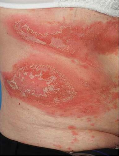 Figure 1. Typical appearance of generalized pustular psoriasis, with areas of edema, erythema, scaling and multiple pustules coalescing into lakes of pus.