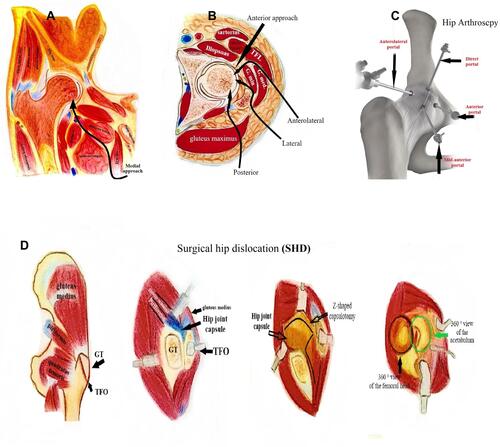 Figure 2 Demonstration of the suggested approaches for the management. (A) Medial approach to the hip. (B) Anterior, anterolateral, lateral, and posterior approaches. (C) Hip arthroscopy. (D) Surgical hip dislocation (SHD).