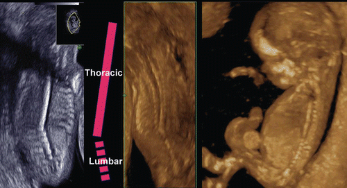 Figure 28.  Fused thoracic vertebral body with scoliosis at 13 weeks of gestation. Left; 2D sagittal image. Thoracic vertebral body is completely fused while lumber vertebral bodies are apart. Middle; 3D maximum mode of dorsal view. Right; 3D maximum mode of lateral view.