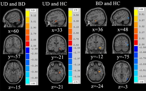 Figure 2 ReHo maps showing significant differences in brain activity between UD group and BD group, UD group and HC group, and BD group and HC group displayed on axial, coronal, and sagittal slices. Numbers indicate x, y, and z slices, and are displayed in MNI coordinates. Red and blue colors denote increased and decreased activity. The color bars indicate the T-value based on two-sample t-test. (p<0.01 AlphaSim correction).