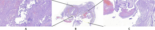 Figure 3 Pathological result of curettage tissue. (A) The first pregnancy after magnification. (B) Histologic assessments confirmed the 2 distinct pregnancies at the same tube. The twins were dichorionic and diamniotic. (C) The second pregnancy after magnification.