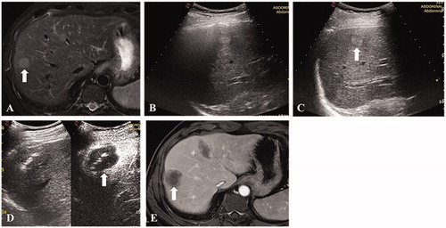 Figure 2. A 48-year-old male. (A) Contrast enhanced MRI indicated a recurrent hepatocellular carcinoma of 12 mm in segment 7. (B) The nodule was completely invisible because of the pulmonary gas. (C) The nodule became completely visible after one-lung ventilation. (D) Thermal ablation was performed and immediate contrast-enhanced ultrasound demonstrated no hyper-enhancement of the tumor. (E) Contrast-enhanced MRI one month after the ablation procedure confirmed the technical efficacy.