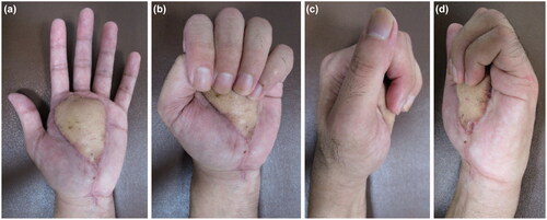 Figure 7. (a–d) No limitation in the ROM of the fingers is observed at the latest follow-up.