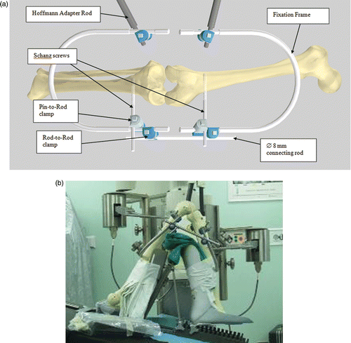 Figure 5. Robot-assisted TKA. The knee was flexed and rigidly fixed by two Schanz screws, fixation frames, connecting rods, pin-to-rod clamps, rod-to-rod clamps and Hoffmann adapter rods.