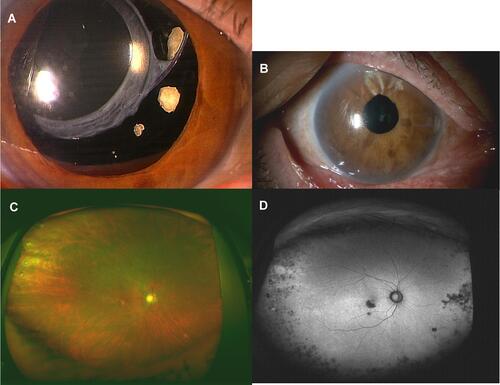 Figure 2 Case 2 was a 76-year-old woman. (A) A superiorly subluxed in-the-bag IOL is present in the left eye at presentation. (B) Sclera-sutured posterior chamber-IOL is stable at 2 years after the implantation surgery. (C) Peripheral and macular multifocal chorioretinal atrophy at 1 year after the surgery. (D) Hypofluorescence corresponding to the chorioretinal atrophy can be seen in a fundus autofluorescent image.