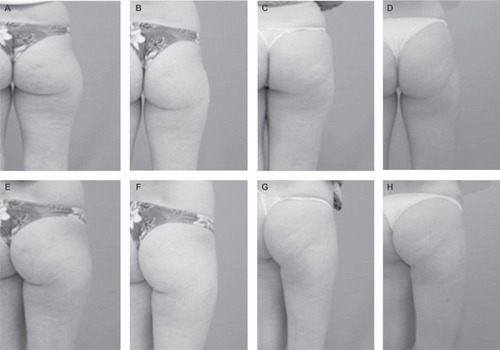 Figure 3 Comparative photographic register of the aspect of cellulite. Notes: (A, C) Rear view of gluteus and posterior right thigh at baseline; (B, D) rear view of right gluteus 7 days after the last carboxytherapy session; (E, G) right side view at baseline; and (F, H) rear view of the right gluteus after the last session of carboxytherapy.