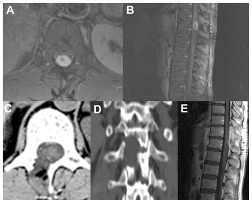 Figure 2 Illustrative case 2. (A and B) Preoperative axial and sagittal magnetic resonance images showing a meningioma of the thoracolumbar junction. (C and D) Postoperative axial and coronal computed tomographic scan demonstrating the minimally invasive unilateral approach. (E) Postoperative magnetic resonance image showing complete tumor resection.