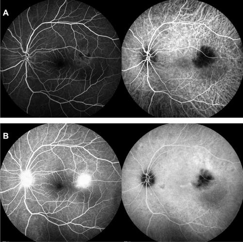 Figure 3 Fluorescein angiography (left) showed hypo-fluorescence in early phase (A) with late leakage (B). Indocyanine green angiography (right) showed hypo-fluorescence throughout the late phase (B).