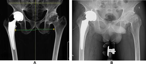 Figure 7 Comparison of preoperative surgical plan and postoperative X-rays of the arthrodesed hip. (A) Robotic surgical plan. (B) Actual postoperative X-rays.