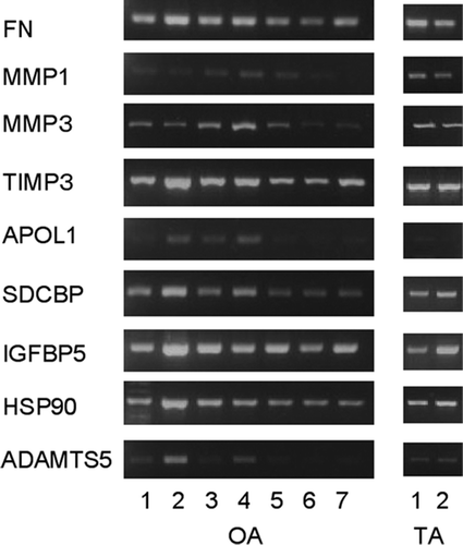 mRNA expression levels from 9 selected genes in synovial tissue from OA and TA synovium by RT–PCR. All 9 genes were expressed in OA and TA synovium. The expression of mRNAs encoding MMP1, APOL1, and ADAMTS5 was weak in some samples from OA, while expression of APOL1 mRNA was weak in control samples (TA). FN: fibronectin 1; MMP: matrix metalloproteinase; TIMP: tissue inhibitor of metalloproteinase; APOL1: apolipoprotein L-I; SDCBP: syndecan binding protein; IGFBP: insulin-like growth factor binding protein; HSP: heat shock protein; ADAMTS: a disintegrin and metalloproteinase with thrombospondin motifs; OA: osteoarthritis; TA: traumatic arthropathy.