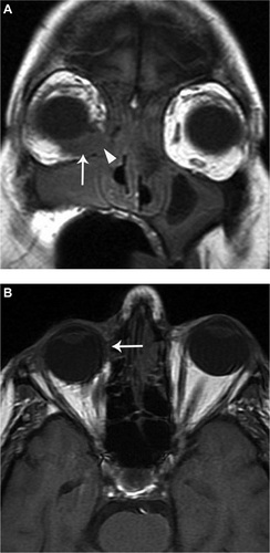 Figure 4 Magnetic resonance (MR) images of the orbits for Case 2. (A) Coronal unenhanced T1-weighted MRI image, approximately 24 hours after surgery, shows a T1 isointense collection in the inferonasal quadrant of the right orbit (arrow), which was most consistent with a hematoma. There is also a bony defect in the medial and inferomedial wall of the orbit (arrowhead) adjacent to the hematoma representing the site of bony penetration. (B) Axial unenhanced T1-weighted MR image from a follow-up MRI, one month after surgery, shows resolution of the hematoma, but there is right enopthalmos and deviation of the globe medially.