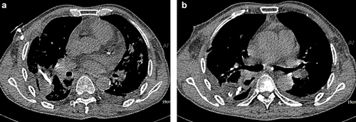 Figure 3 (a and b) Images of chest computed tomography scan of the significant resolution of the empyema cavity and pulmonary inflammation.