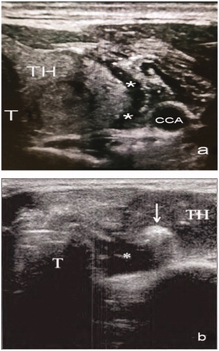Figure 4. (a) Liquid-isolating zone between the thyroid and the common carotid artery. (b) Liquid-isolating zone between the thyroid and trachea (↓, hyperechoic zone after ablation; *, liquid-isolating zone; TH, thyroid; T, trachea; CCA, common carotid artery).