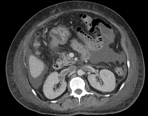Figure 2 Contrast-enhanced CT image shows linear hypodense thrombus in IVC and bilateral renal veins.