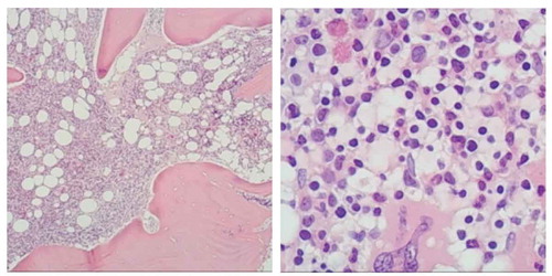 Figure 3. Bone marrow biopsy: HE and PAS staining showed more active bone marrow hyperplasia (70%), lymphocytosis (40–50%), focal and scattered distribution, infiltrating lesions were mostly located next to the trabecular, small cell bodies, irregular nuclei. The mature erythroid cells are scattered and the number of megakaryocytes is roughly normal. Reticulated fiber dyeing (MF-2 grade)