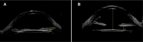 Figure 2 Comparative ultrabiomicroscopies of both eyes. (A) Right eye. The intraocular lens is displacing the iris forward. There is an echo-negative space between the intraocular lens and the distended posterior capsule. (B) Left eye. A normally placed intraocular lens. There is no abnormal contact with any surrounding structure.