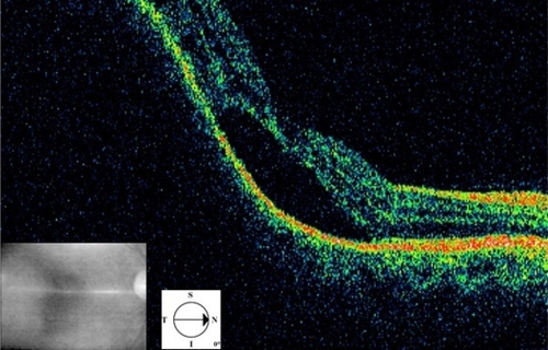 Figure 6 Case 2. Optical coherence tomography. Serous retinal detachment and elevation of the retina depending on a choroidal mass.