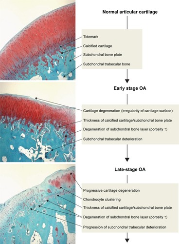 Figure 1 Osteochondral damage during the progression of OA.Notes: OA subchondral bone is known to be hypomineralized and to show abnormal bone metabolism, resulting in histopathological degeneration of subchondral bone as well as cartilage damage. During progression of OA, the subchondral bone is also damaged as well as the articular cartilage layer. Injuries of either tissue adversely affect the mechanical environment as well as the homeostatic balance of the entire joint, resulting in the development of OA.Abbreviation: OA, osteoarthritis.