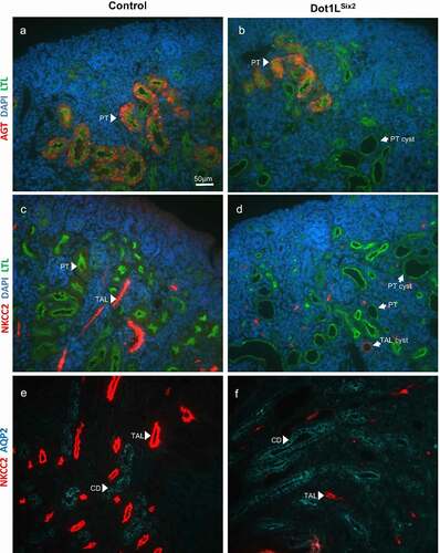 Figure 5. Dot1LSix2 renal cysts are predominantly of proximal tubule origin. Section immunofluorescence of P0 Control and mutant Dot1LSix2 using markers of proximal tubule (angiotensinogen [AGT], LTL), thick ascending limb of Henle (NKCC2), and collecting duct (AQP2). (a, b) In (a) AGT and LTL decorate the proximal tubules in control kidney. In (b) some less affected LTL-positive tubules retain AGT staining, whereas de-differentiated cystic-dysplastic tubules lost AGT staining. (c, d) In control kidney (c), LTL-positive proximal tubules and NKCC2-positive thick ascending limb of Henle-positive tubules are seen in the inner cortex. In mutant kidney (d), the majority of cystic-dysplastic tubules are LTL-positive; only one cystic structure is NKCC2-positive. Note the reduction in number of NKCC2-positive segments in mutant kidneys. (e, f) Staining of AQP2 reveals no evidence of cystic changes in the collecting ducts of mutant kidneys. PT: proximal tubules, TAL: thick ascending limb of Henle, CD: collecting duct. N = 5/group