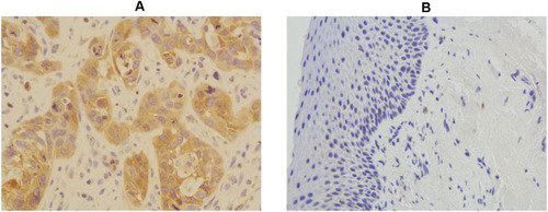 Figure 1 HK-II expression in laryngeal carcinoma tissues (A) and in paracarcinoma tissues (B).