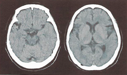 Figure A.1. Cranial plain computed tomography (case 2).