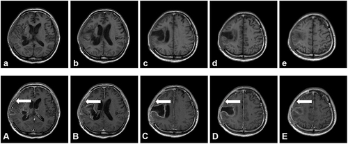 Figure 2 Brain MRI images on August 25 demonstrated post-cerebral hemorrhage in the right frontal lobe, temporal lobe, right basal ganglia, and thalamus, and the softening of the focus (a-e). The marginal enhancement of the operative area was considered to be a consequence of postoperative repair changes. The meninges indicated with the arrow was located in the right temporal region were enhanced and was considered to be inflammatory, Epidural marked curve demonstrated significant contrast enhancement following intravenous gadolinium administration (A–E) and there was slight subdural effusion in the right frontal area.