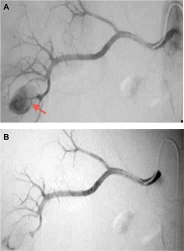 Figure 2 Right renal artery arteriogram findings.