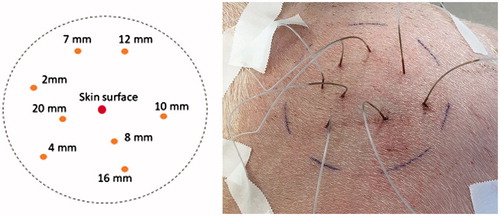 Figure 3. Template for sensor positions and tissue depths at which temperature measurements were performed (left), marked target field with inserted temperature sensors (right). The sensors were inserted through catheters (type: SURFLO IV Catheter and SUPERFLASH IV Catheter, TERMURO, Tokyo, Japan).