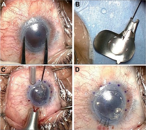 Figure 1 Surgical technique of non-Descemet’s stripping automated endothelial keratoplasty in case 2. (A) Under the surgical microscope, the recipient corneal size was horizontal 9.0 mm × vertical 7.5 mm, and the donor diameter was determined as 6.0 mm. (B) A 6.0 mm diameter donor lamella, in which the endothelial surface was coated with viscoelastic material, was loaded into the Busin glide. (C) Without recipient descemetorhexis, the donor lamella was easily inserted into the anterior chamber with a pull-through technique using the sheets glide and the Busin glide. Note the violet dot marking was 8.0 mm in diameter. (D) after securing the wound with an interrupted 10-0 nylon suture, air was injected to press the donor tissue against the recipient cornea.