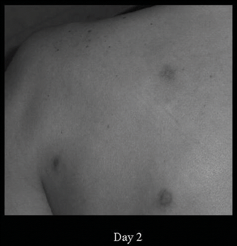 Fig. 2. Skin lesions on second hospital day. The cutaneous hemorrhage changes into a necrotic lesion.